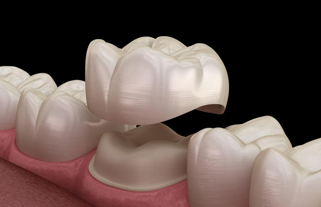 dental crowns