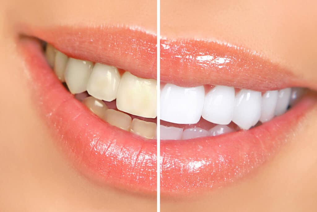 teeth whitening